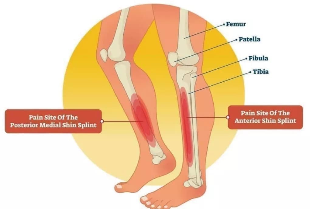 シンスプリント
