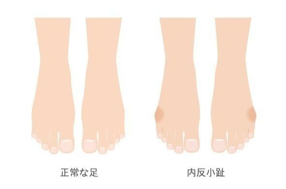 内反小趾